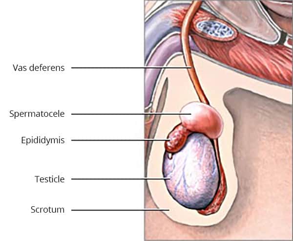 testicular epidermoid cyst
